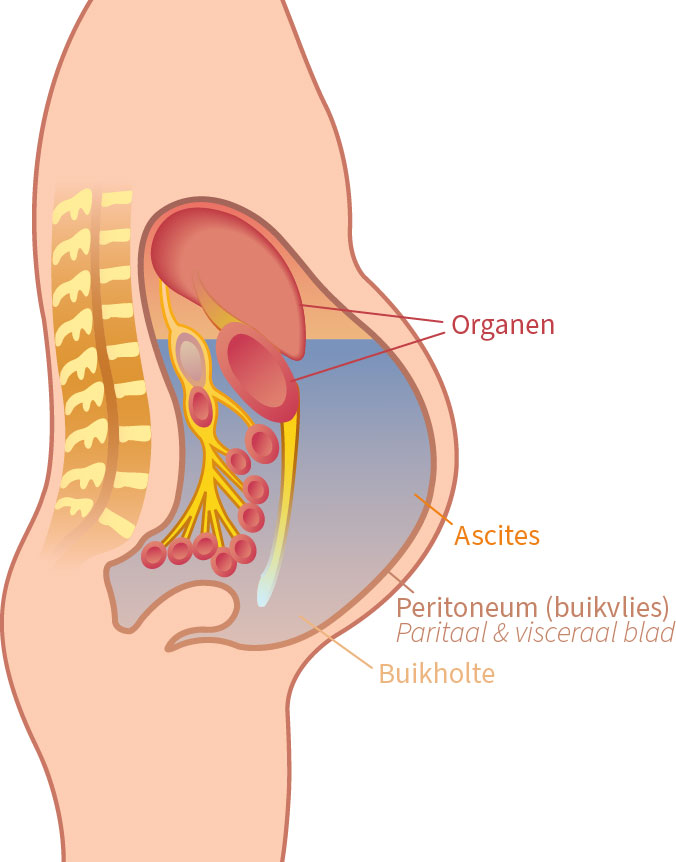 Illustratie van buikvlies met ascites